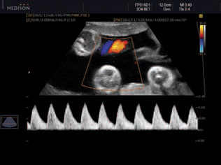 Köldökzsinór zoomolt triplex Doppler képe