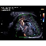 Magzati Doppler kép - Accuvix A30